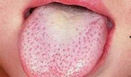 吃瓜感觉舌头有点刺